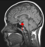 Hypotalamus i hjärnan
